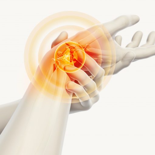 3D Animation von einem Schmerzendem Handgelenk