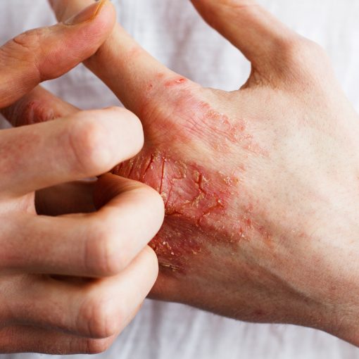 Man mit Psoriasis kratzt sich seine trockene Hand auf