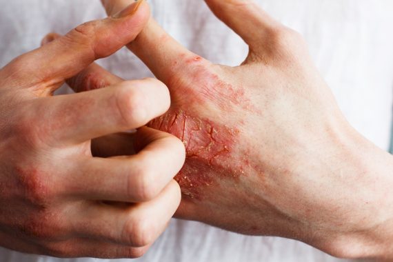 Man mit Psoriasis kratzt sich seine trockene Hand auf